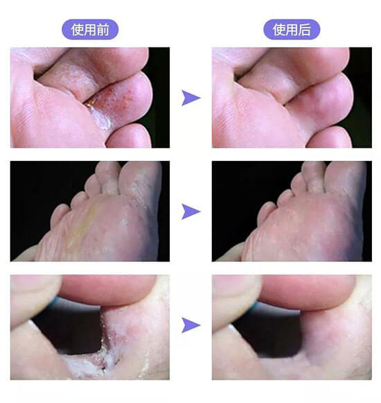 治脚气用什么泡脚最好?龙源帮你告别脚气